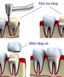 BỌC RĂNG SỨ THẨM MỸ