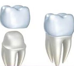 BỌC RĂNG SỨ THẨM MỸ