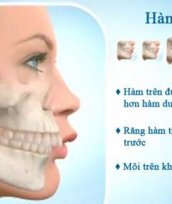 CHI PHÍ NIỀNG RĂNG HÔ