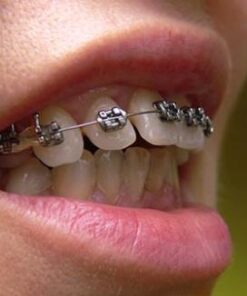 CHI PHÍ NIỀNG RĂNG HÔ