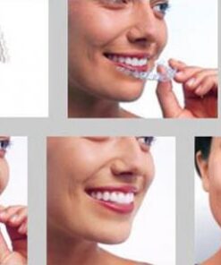 CHI PHÍ NIỀNG RĂNG HÔ