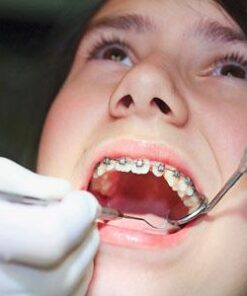 CÓ NÊN NIỀNG RĂNG CHO TRẺ