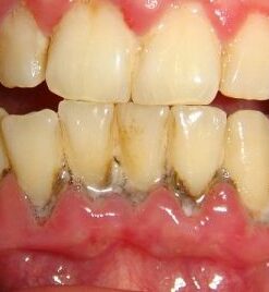 CẠO VÔI, ĐÁNH BÓNG RĂNG