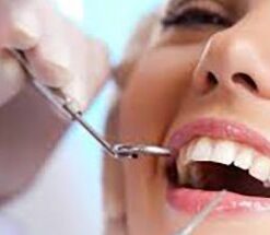 CẠO VÔI, ĐÁNH BÓNG RĂNG