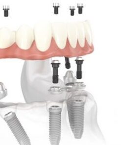 CẤY GHÉP IMPLANT