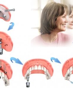 CẤY GHÉP IMPLANT ALL ON 4