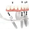 CẤY GHÉP IMPLANT ALL ON 4
