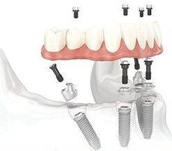CẤY GHÉP IMPLANT ALL ON 4