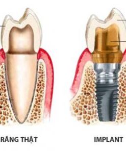 CẤY GHÉP IMPLANT CÓ ĐAU KHÔNG