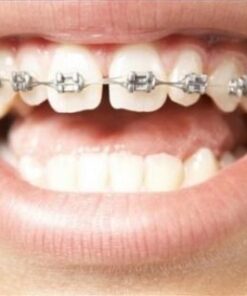 GIÁ CẢ NIỀNG RĂNG 1 HÀM