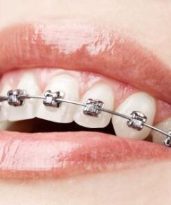 GIÁ CẢ NIỀNG RĂNG 1 HÀM