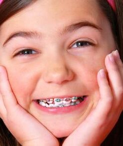 GIÁ CẢ NIỀNG RĂNG 1 HÀM