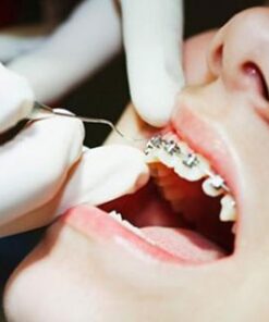 GIÁ CẢ NIỀNG RĂNG 1 HÀM