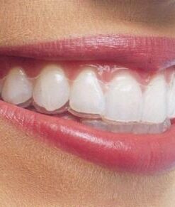 GIÁ NIỀNG RĂNG KHÔNG MẮC CÀI INVISALIGN