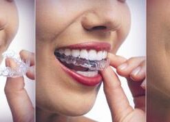 GIÁ NIỀNG RĂNG KHÔNG MẮC CÀI INVISALIGN