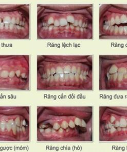 NIỀNG RĂNG HÔ BAO NHIÊU TIỀN