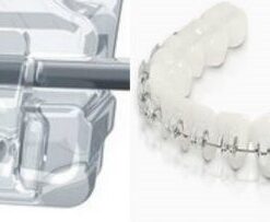 NIỀNG RĂNG MẮC CÀI