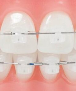 NIỀNG RĂNG MẮC CÀI SỨ BAO NHIÊU TIỀN