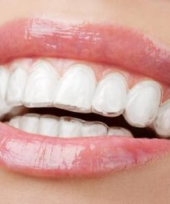 NIỀNG RĂNG THẨM MỸ GIÁ BAO NHIÊU