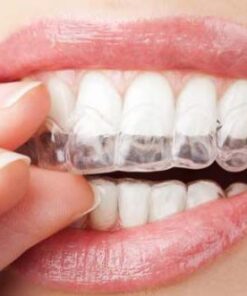 NIỀNG RĂNG TRONG SUỐT GIÁ BAO NHIÊU