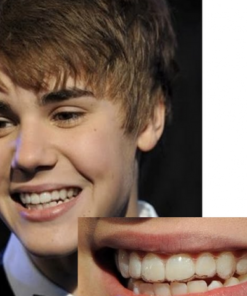 NIỀNG RĂNG TRẺ EM