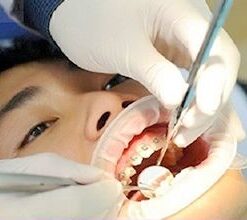 NIỀNG RĂNG TỐT Ở HÀ NỘI