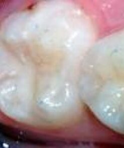 TRÁM PHÒNG NGỪA SÂU RĂNG