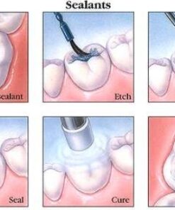 TRÁM PHÒNG NGỪA SÂU RĂNG