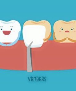 VENEER SỨ
