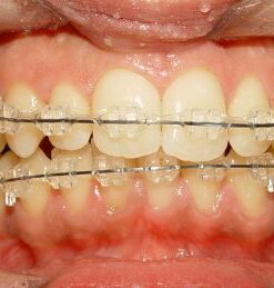 ĐIỀU TRỊ RĂNG MỌC LỆCH