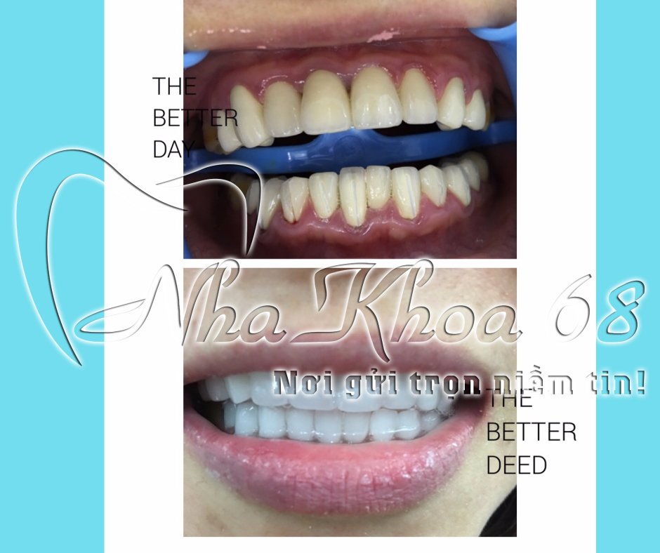 Phương pháp trồng răng sứ mất bao lâu thời gian